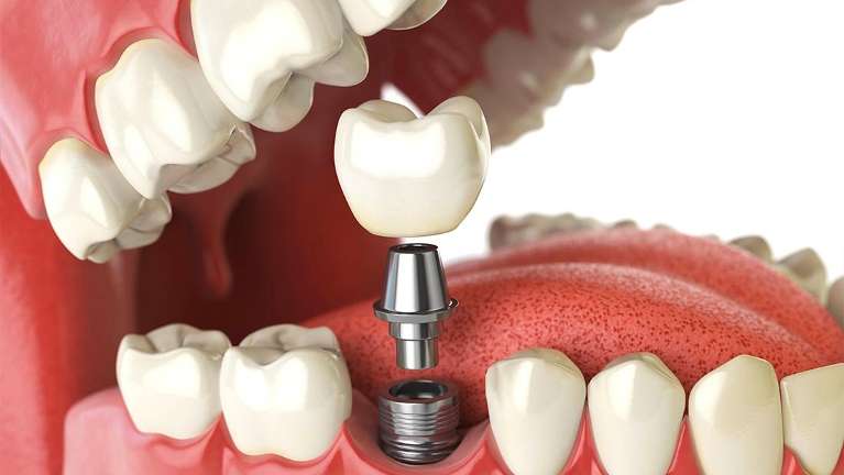 close up of dental implant in jaw | dental implants clifton hill vic