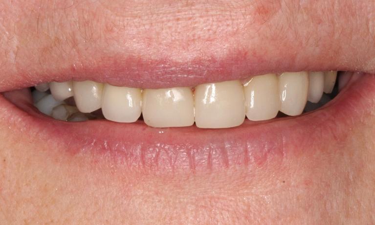 Full-Mouth-Reconstruction-After-Image