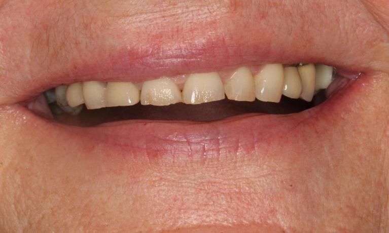 Full-Mouth-Reconstruction-Before-Image