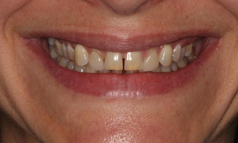 What is cosmetic dentistry?  Smile Makeover Northcote VIC