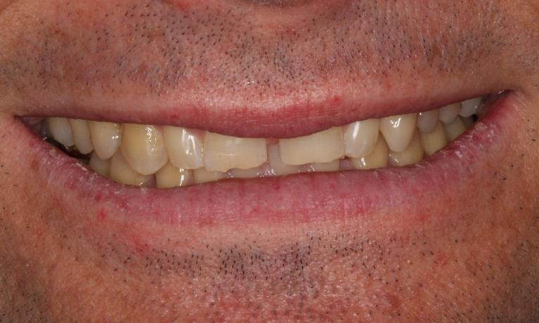 Porcelain-and-Composite-Veneers-with-Whitening-Before-Image